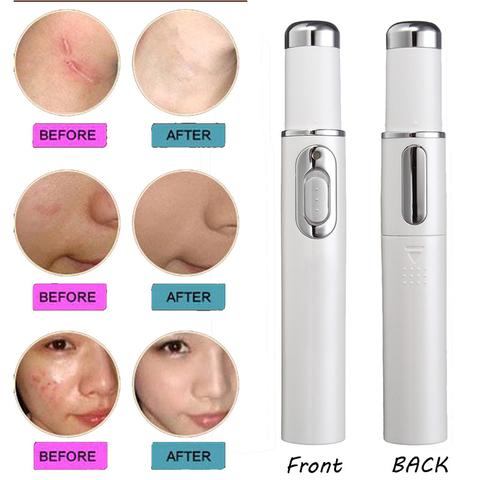 Acne Laser Pen